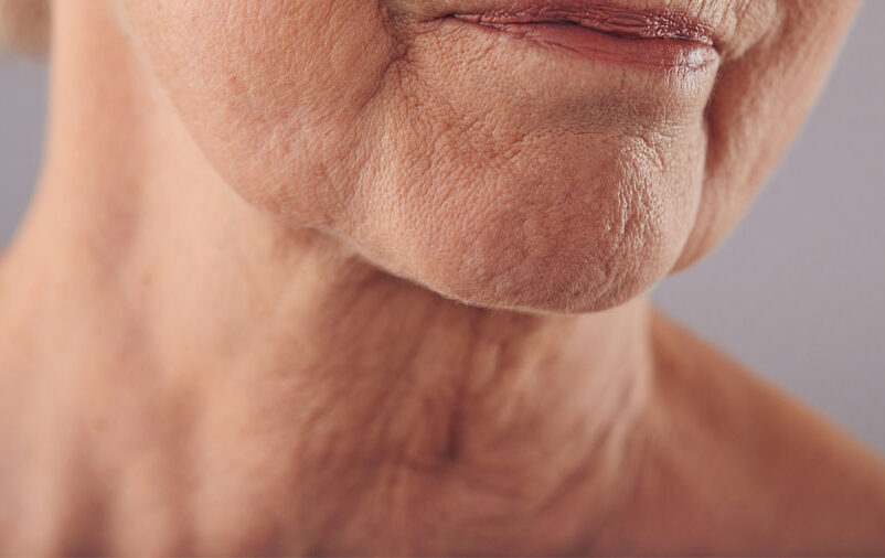 amenizar as rugas no pescoço