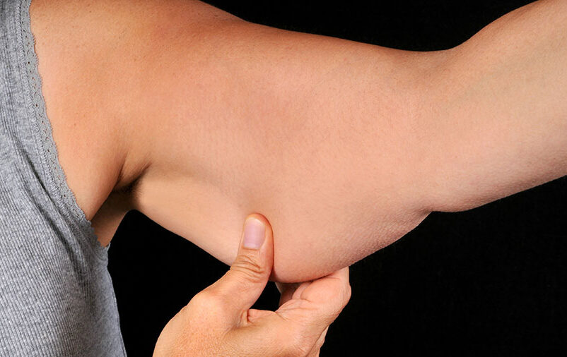 nsinamos como tratar a flacidez nos braços