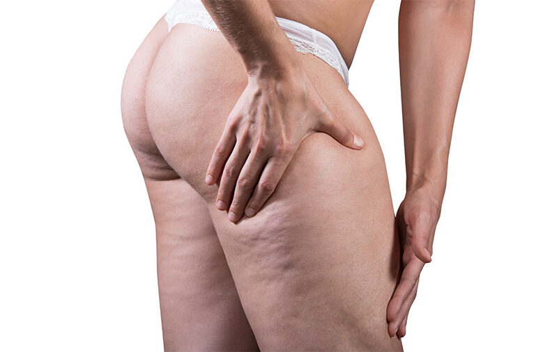 como reduzir a celulite sem sofrer tanto