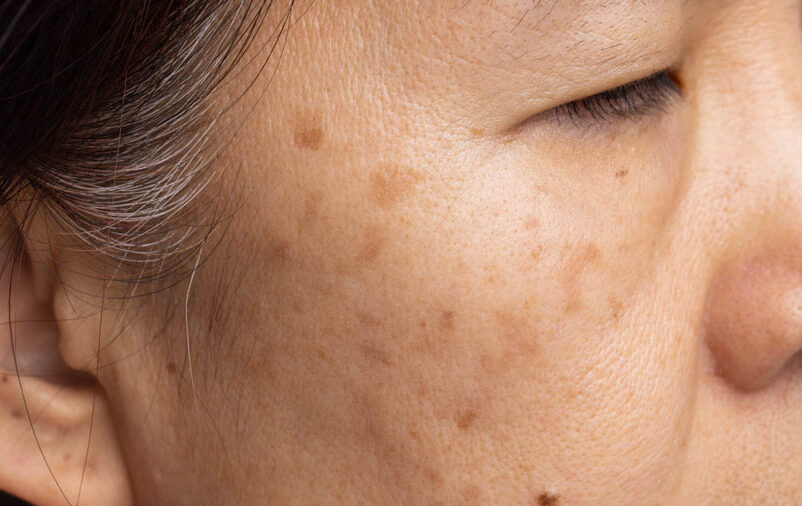 tratamento do Melasma