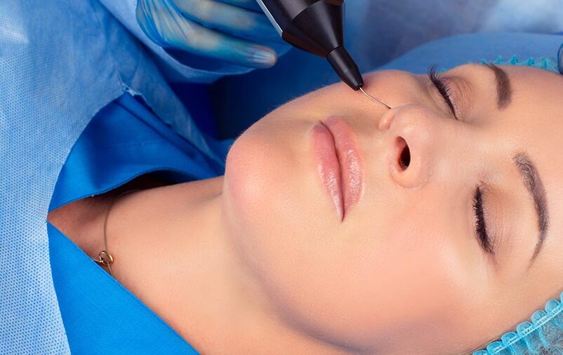 Aplicação do jato de plasma facial. Veja o que é!